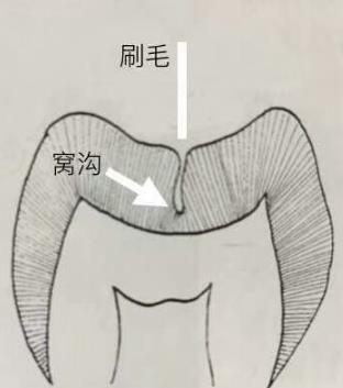 儿童窝沟封闭需要多少钱