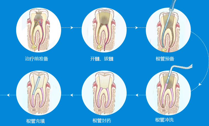 后牙做显微根管治疗多少钱？