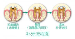 正规医院补牙要多少钱