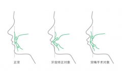 牙齿前突可以做烤瓷牙吗