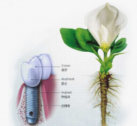  深圳种植牙多少钱一颗？