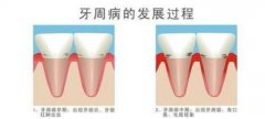 深圳牙周炎的治疗多少钱？