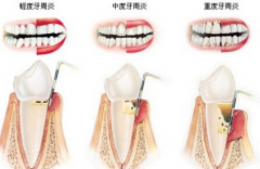 深圳牙周炎治疗哪家医院好？