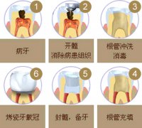 根管治疗后牙齿能用多久