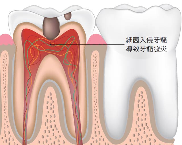 牙髓炎出现时的症状