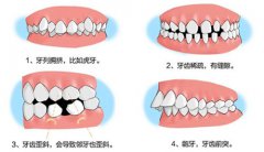 影响脸型发育的错颌畸形有哪些