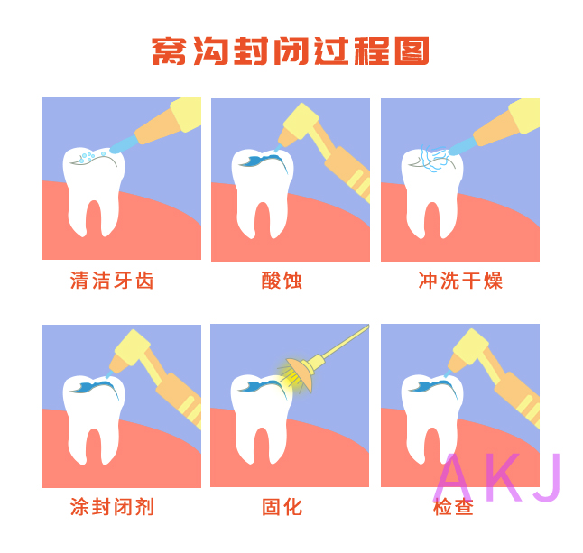 窝沟封闭
